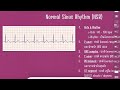 easy basic ekg จบใน 50 นาที i nursenotestudio