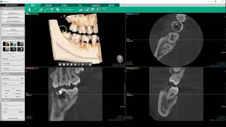 ATOM ACX05 - Modalità endodontica