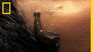 Leeches Cure | National Geographic