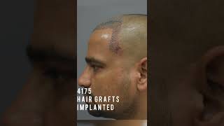 5 Months Hair Transplant Results [Before After] #hairtransplantinindia