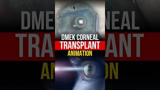 DMEK Corneal Transplant Surgery | Detailed Animated Procedure