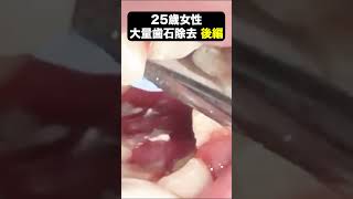 【25歳女性】完全版後編25歳女性の大量歯石Remove tartar牙石去除Complete ed  latter part歯石除去 ショート