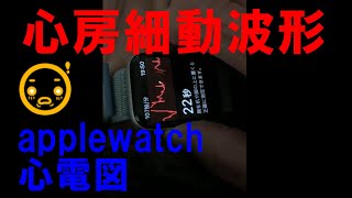 アップルウォッチ心電図で見た不整脈（心房細動）波形　applewatch　atrial fibrillation