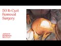 Large Abdominal Cyst Removal Surgery with ENSEAL X1 Large Jaw | J&J MedTech