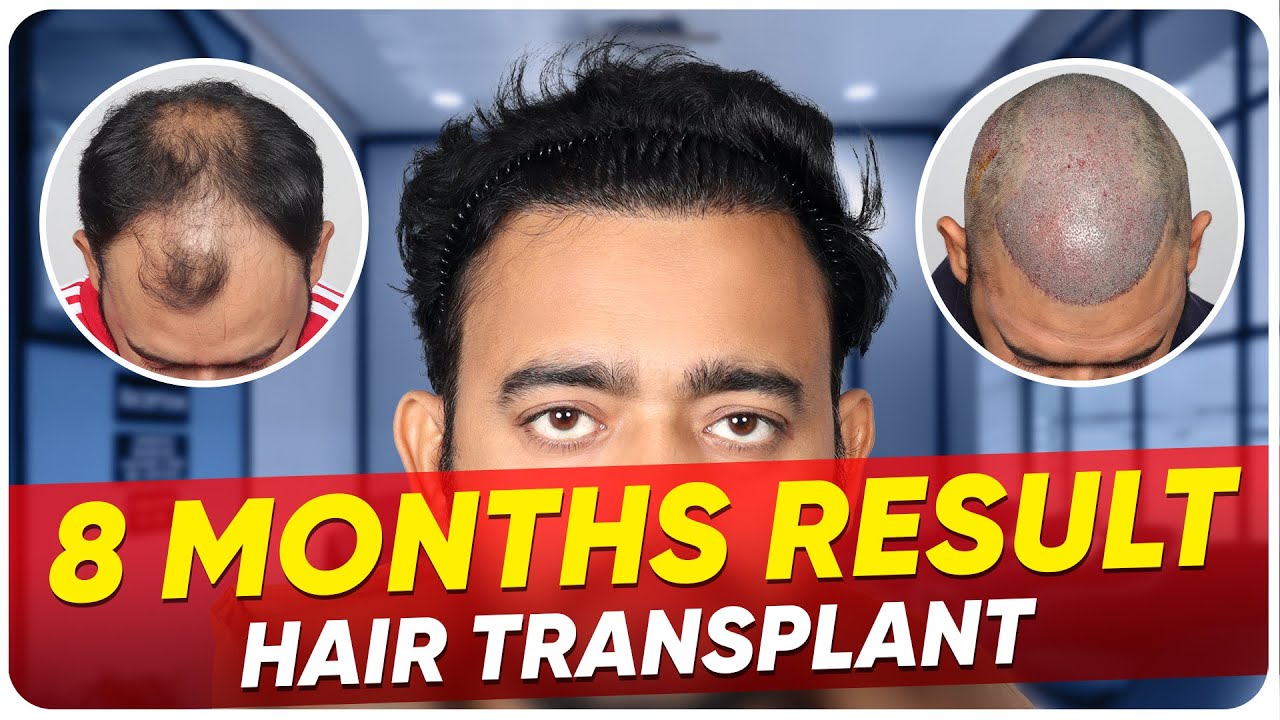 Hair Transplant In Bangalore | Best Results & Cost Of Hair Transplant ...