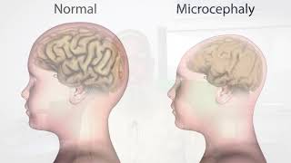 Microcephaly কি এবং এর চিকিৎসা!  || অধ্যাপক ডাঃ মোঃ মিজানুর রহমান