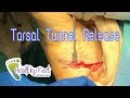 Tarsal Tunnel Release With Plantar Fasciitis Surgery