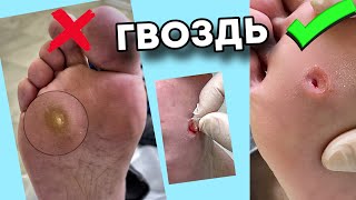 Выросла за 1 месяц | ощущения острого гвоздя | удаление онлайн со звуком #подологтатьянапак #мозоль