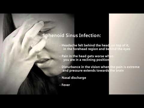 Symptoms Of A Sinus Infection Symptoms Of A Sinus Infection