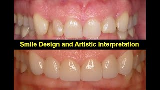 Smile Design and Artistic Interpretation