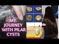 My Journey with Pilar Cysts on my Scalp | Removal + Aftercare VLOG