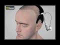 #HairForever #Hairtransplant - #FUEtechnique v/s #FUTtechnique - Final