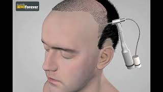 #HairForever #Hairtransplant - #FUEtechnique v/s #FUTtechnique - Final