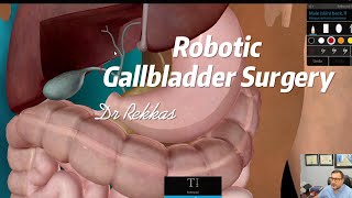 Robotic Gallbladder Surgery