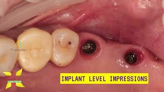 Direct sinus lift with dental implants and bone grafting