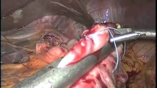 laparoscopic Roux-En-Y-Gastric Bypass Reversal