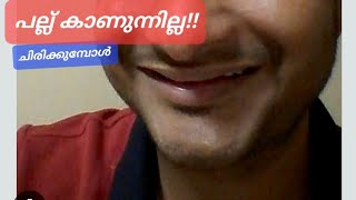 പല്ല് കാണുന്നില്ല  ചിരിക്കുമ്പോൾ??  pallilkambiidunnath malayalam/braces / venners/palludr /dentist