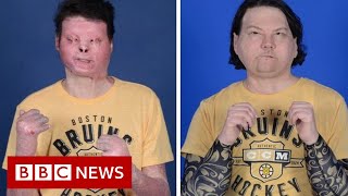 First successful face and double hand transplant - BBC News