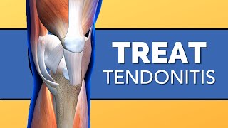 How to Treat Tendonitis of the Knee?