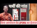 बिना ऑपरेशन के लाइपोमा का इलाज! Lipoma treatment ! Skin tumer Homeopathic Medicine #lipoma#ganthilaj