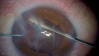 Dr Stanimir  Troshev Livestream- Traumatic cataract