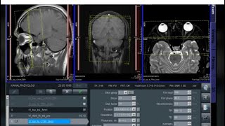 Orbita MR +C  Nasıl Çekilir? KANAL RADYOLOJİ ORBİTA MR ORBİTS MRG MAGNETİC RESONANCE