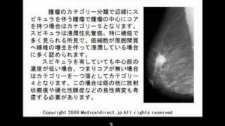 マンモグラフィの基礎：構築の乱れ Architctural distortion 1