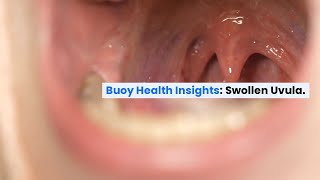 Swollen Uvula: Common Causes and When to Seek Medical Care | BuoyHealth.com