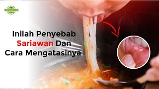 Perlu Diketahui ! Inilah 5 Penyebab Sariawan dan Cara Mengatasinya