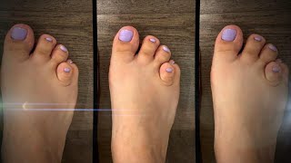 Woman Shares How Her Short Toe Has Impacted Her Life