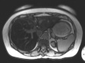 Hepatic Steatosis