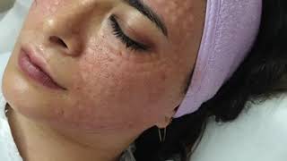 Aquashine soft biorevitalizasiya proseduru. Aquashine soft biorevitalisation procedure