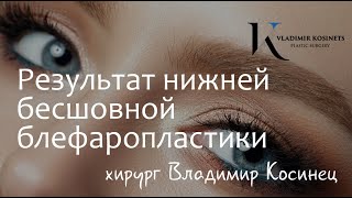 Нижняя трансконъюнктивальная блефаропластика. Хирург Владимир Косинец