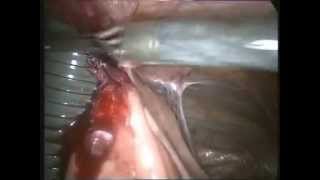 Laparoscopic Lysis of Adhesions  8