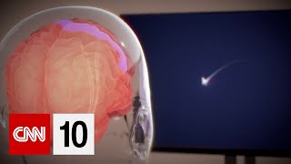 Elon Musk’s Neuralink implants chip in its first human brain | February 1, 2024