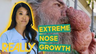 Dr. Lee Sees Man With An Extreme Nose Growth | Dr Pimple Popper: Pop Ups