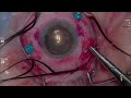 external needle drainage in a patient with a retinal detachment