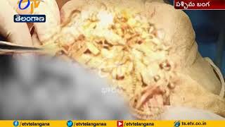 Surgeons Remove 1680 Grams Metal Objects | From Woman's Stomach | at Rampurhat