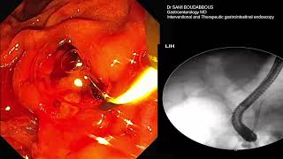 Angiocholite lithiasique aves sepsis grave