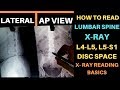 Lower Back X RAY How to Read, L4 L5 S1 Lumbosacral X Ray Reading, Lumbar Spine X RAY Complete Study
