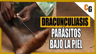 Dracunculiasis - El Parásito de 1 metro que habita bajo La Piel - El Gusano de Guinea EXPLICADO