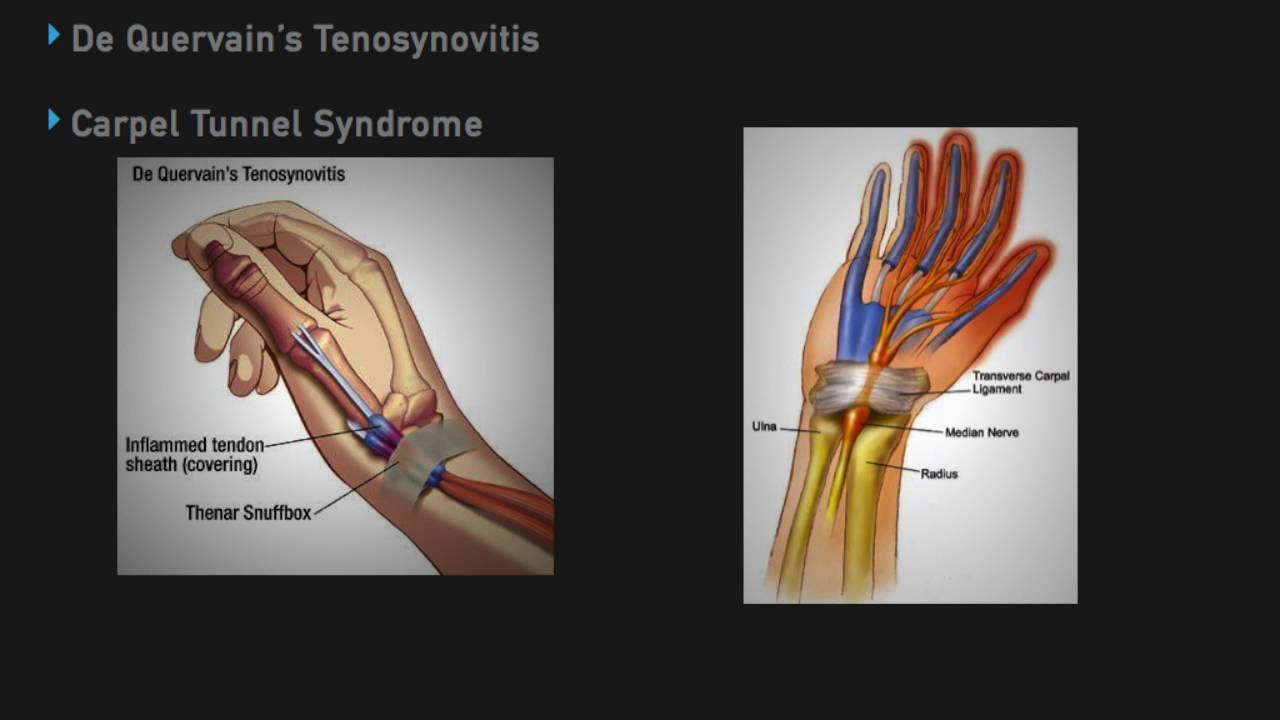 How To Do Intra Articular Injections - YouTube