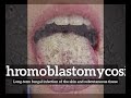 What is Chromoblastomycosis? | How Does Chromoblastomycosis Look?