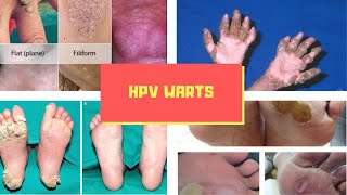 HPV Warts Symptoms – Causes Symptoms and Pictures of HPV Virus Warts in Men women