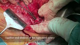 En bloc resection of giant retroperitoneal liposarcoma involving the right colon.