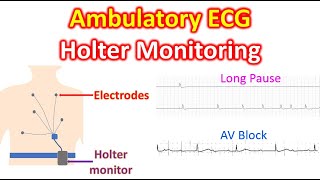 Ambulatory ECG: Holter Monitoring