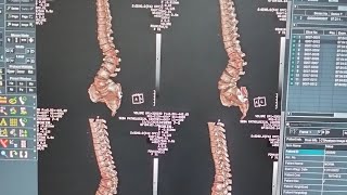 3D Ct scan  of  lumber  Spain