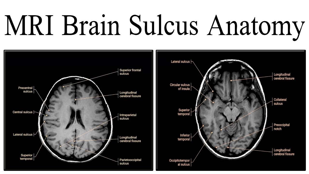 MRI Brain Sulcus Anatomy - YouTube