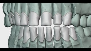 B4D Dental Modules - Crown Module in action