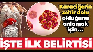 BU BELİRTİLER KARACİĞERİNİZİN TOKSİNLERLE DOLU OLDUĞUNU GÖSTERİYOR-Karaciğerin Zehir Dolu İşaretleri